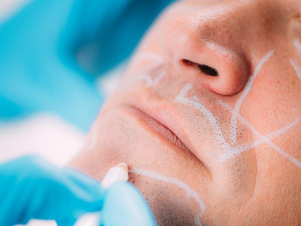 Dermal Fillers for Men. Marking Man’s Face Before Dermal Filler Treatment